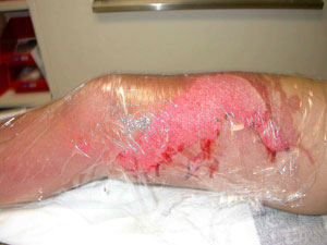 After cooling, cover the wound with a sterile dressing. Use clean plastic film wrap if no dressings are available Copy