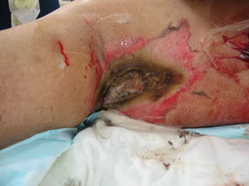 Full thickness exit wound to armpit post high voltage electrical burn injury Copy
