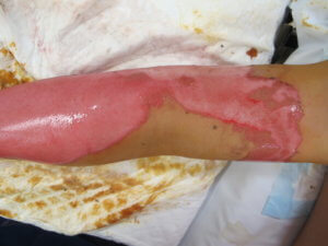 Once healed, minor burns require sun protection, moisturiser, itch and scar management. (copy)