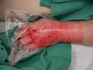 Swelling needs to be minimised to optimise wound healing (copy)