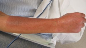 Erythema is not included in overall %TBSA (copy)
